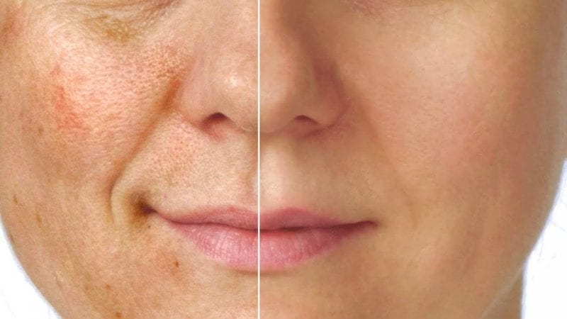 7 طرق طبيعية لمواجهة تصبغ الوجه المزعج