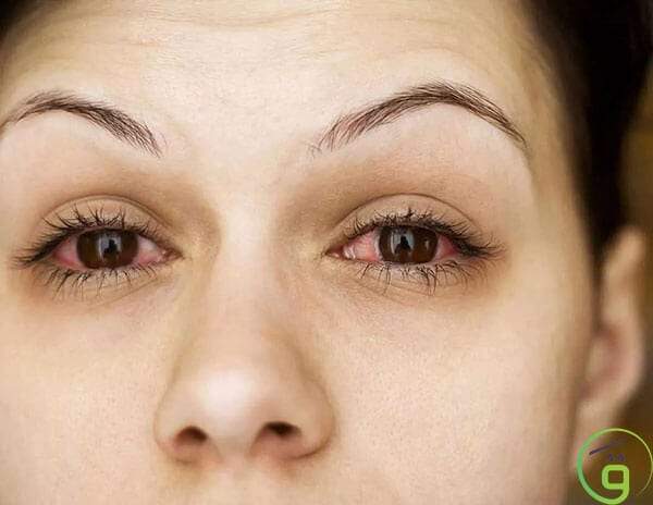 أعراض الاكتئاب على العين