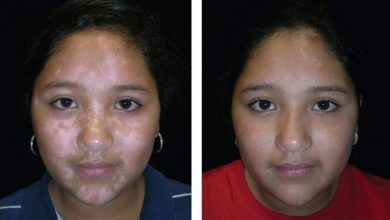 بهاق الأطفال