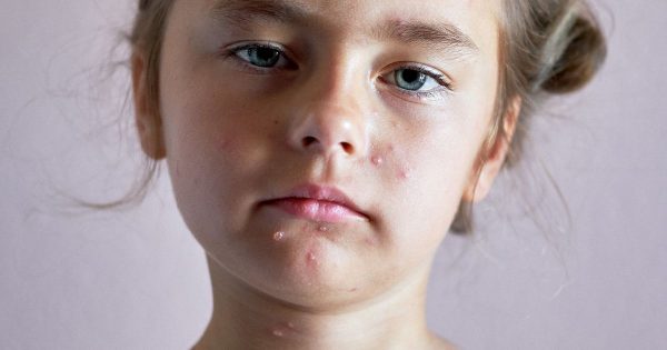 الطفح الجلدي عند الأطفال