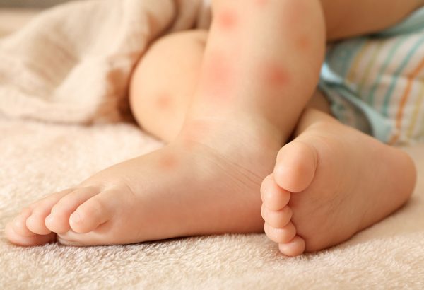 حساسية الألبان عند الرضع