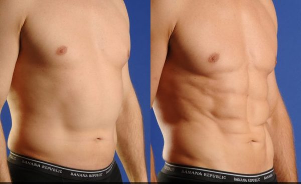 ترهل البطن للرجال