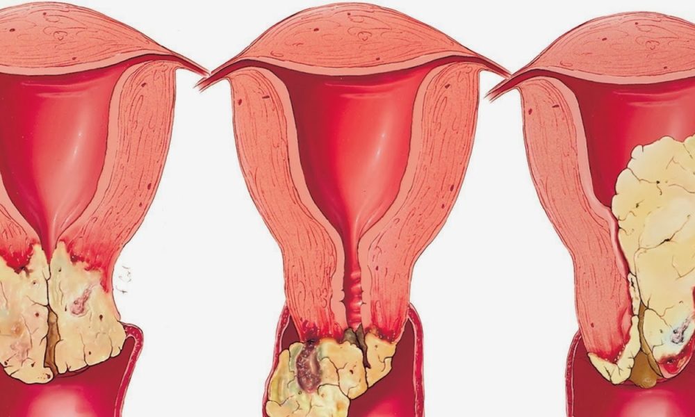 كيف تقي نفسكِ الفطريات المهبلية منزليا؟ فطريات-المهبل