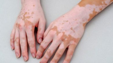 كل-ما-عليك-معرفته-البهاق