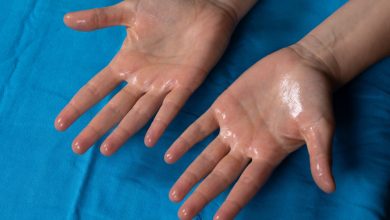 تعرق اليدين والقدمين وأبرز طرق العلاج