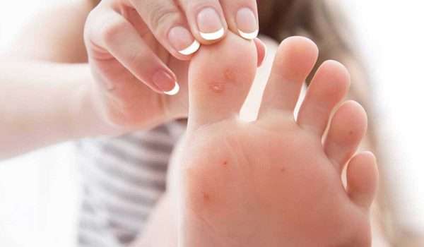 شكل عين السمكة بعد ازالتها