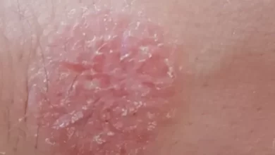 ظهور بقع حمراء على الجسم بدون حكة