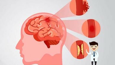 علاج جلطة المخ عند كبار السن