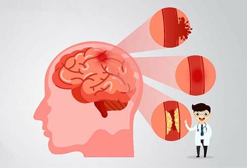 علاج جلطة المخ عند كبار السن