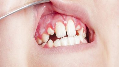 علاج التهاب اللثة وانتفاخها في المنزل للاطفال