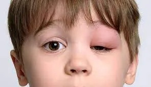 أنواع تورم العين عند الأطفال